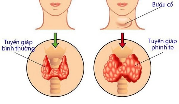 100+ Hình Ảnh Bướu Cổ Đơn Thuần 2026 - Bộ Sưu Tập Độc Đáo, Đẹp Nhất 100+ Hình Ảnh Bướu Cổ Đơn Thuần 2026 - Bộ Sưu Tập Độc Đáo, Đẹp Nhất