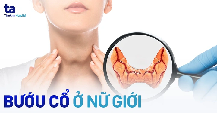 100+ Hình Ảnh Bướu Cổ Đơn Thuần 2026 - Bộ Sưu Tập Độc Đáo, Đẹp Nhất 100+ Hình Ảnh Bướu Cổ Đơn Thuần 2026 - Bộ Sưu Tập Độc Đáo, Đẹp Nhất