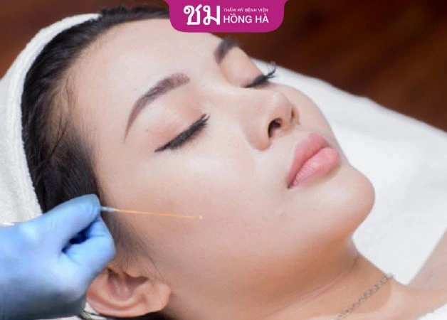 100+ Hình Ảnh Căng Chỉ Collagen 2026 - Bộ Sưu Tập Đẹp Nhất