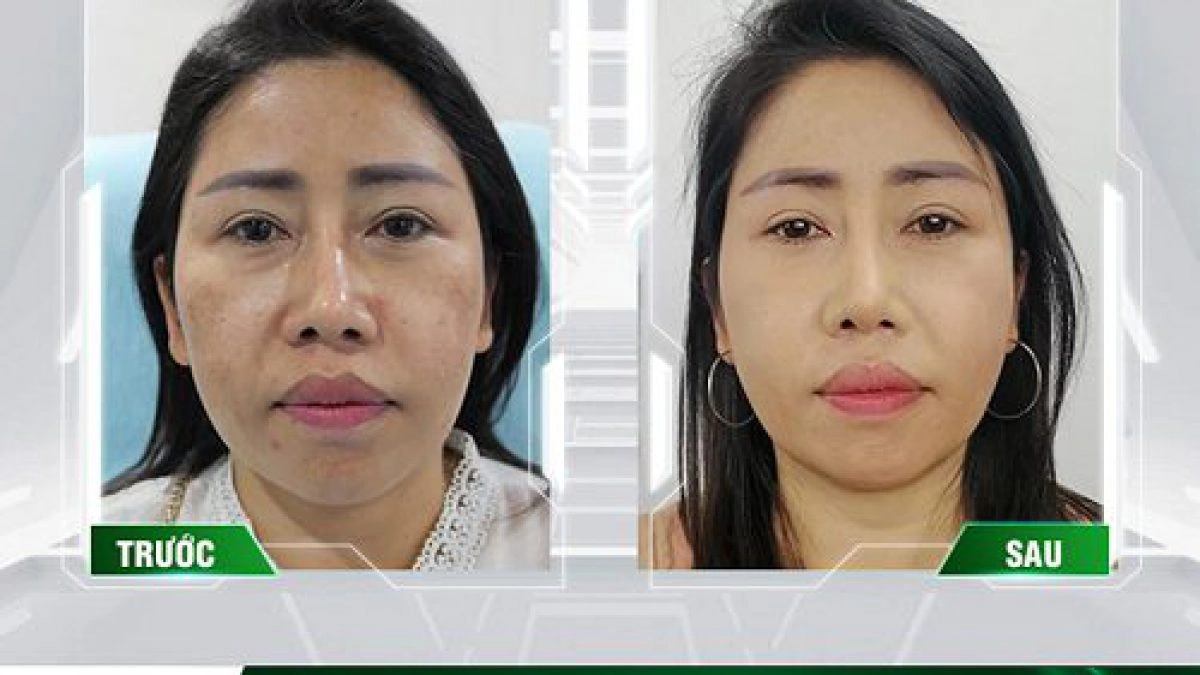 100+ Hình Ảnh Căng Chỉ Collagen 2026 - Bộ Sưu Tập Đẹp Nhất