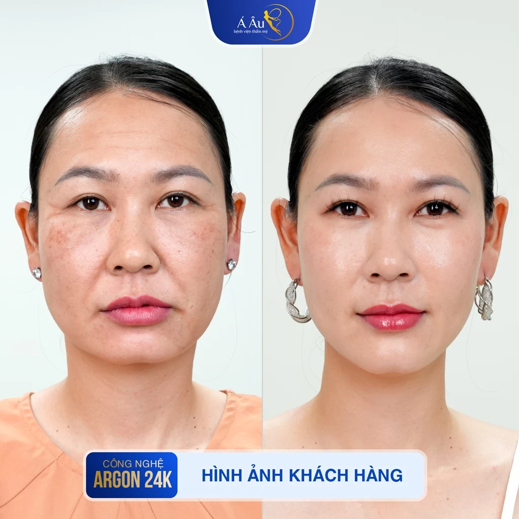 100+ Hình Ảnh Căng Chỉ Collagen 2026 - Bộ Sưu Tập Đẹp Nhất