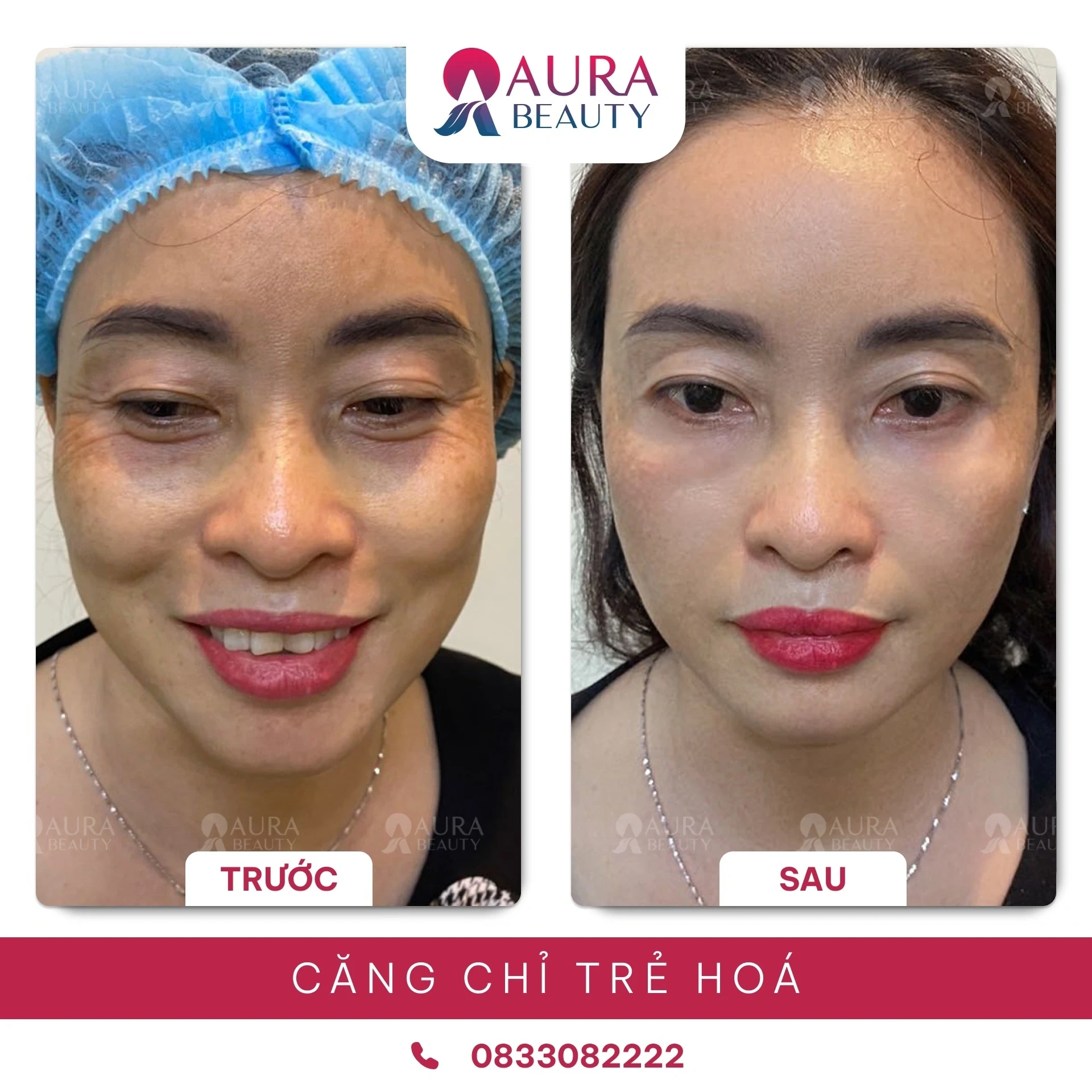 100+ Hình Ảnh Căng Chỉ Collagen 2026 - Bộ Sưu Tập Đẹp Nhất