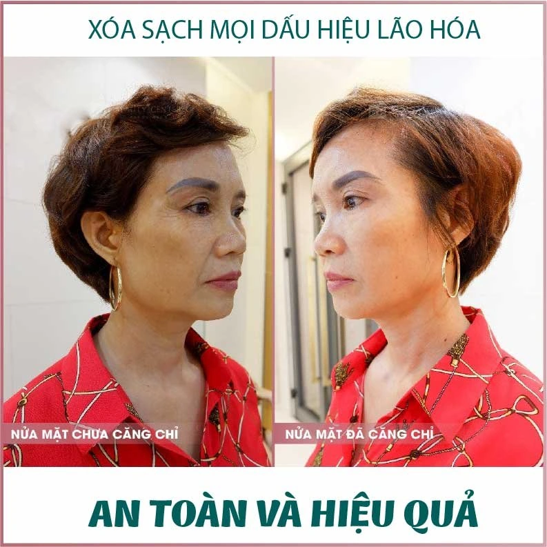 100+ Hình Ảnh Căng Chỉ Collagen 2026 - Bộ Sưu Tập Đẹp Nhất