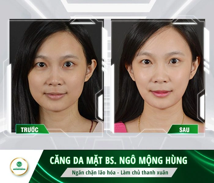 100+ Hình Ảnh Căng Chỉ Collagen 2026 - Bộ Sưu Tập Đẹp Nhất