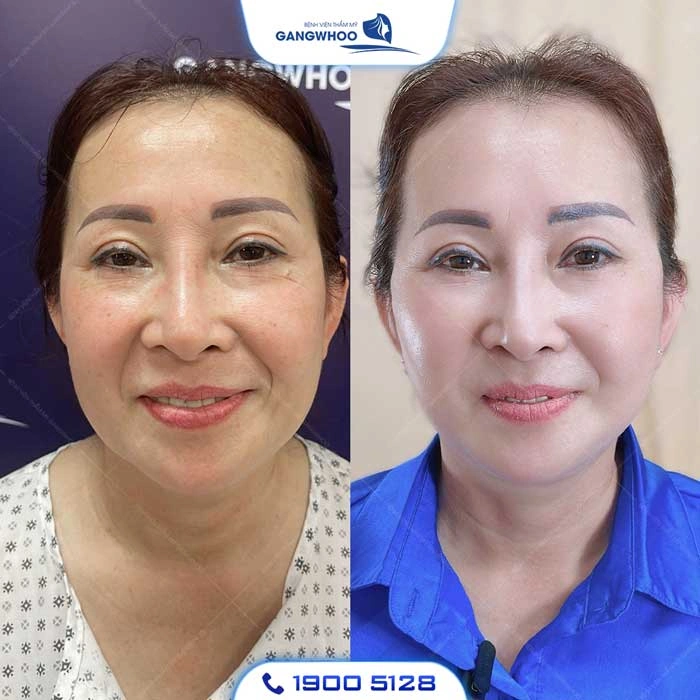 100+ Hình Ảnh Căng Chỉ Collagen 2026 - Bộ Sưu Tập Đẹp Nhất
