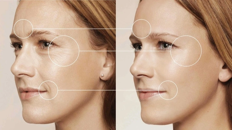 100+ Hình Ảnh Căng Chỉ Collagen 2026 - Bộ Sưu Tập Đẹp Nhất