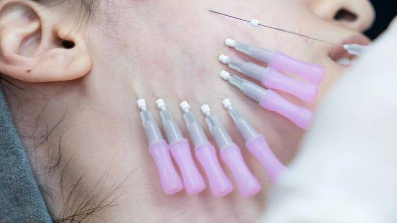 100+ Hình Ảnh Căng Chỉ Collagen 2026 - Bộ Sưu Tập Đẹp Nhất