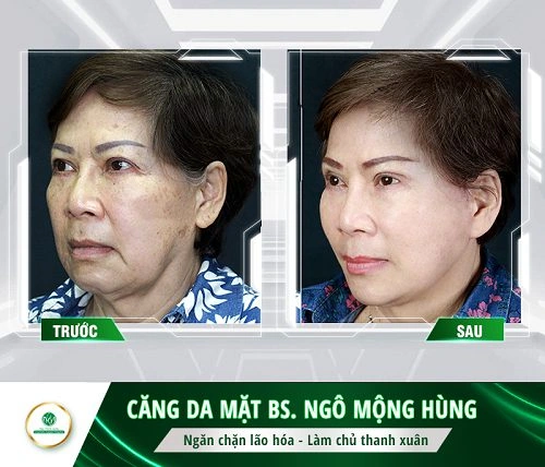 100+ Hình Ảnh Căng Chỉ Collagen 2026 - Bộ Sưu Tập Đẹp Nhất