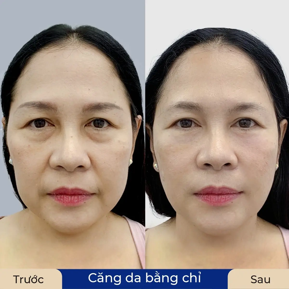 100+ Hình Ảnh Căng Chỉ Collagen 2026 - Bộ Sưu Tập Đẹp Nhất