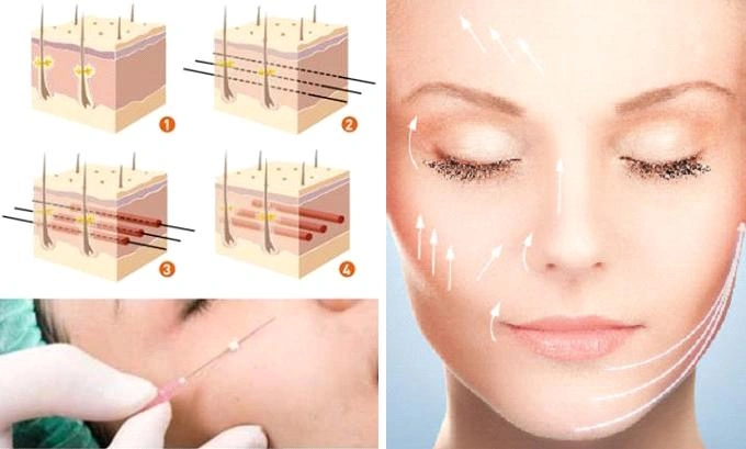 100+ Hình Ảnh Căng Chỉ Collagen 2026 - Bộ Sưu Tập Đẹp Nhất