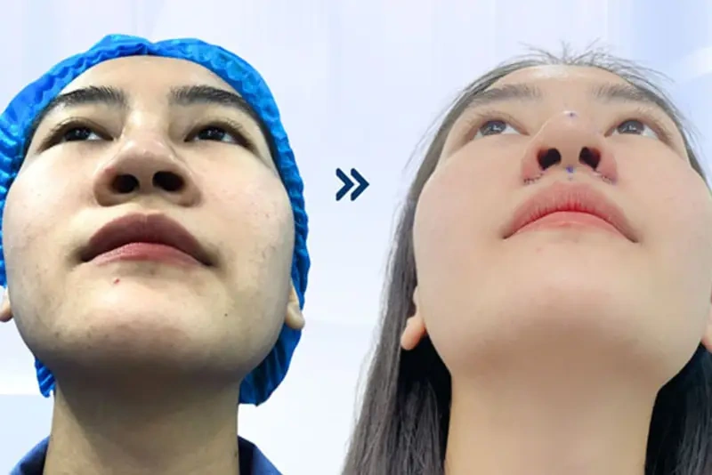 100+ Hình Ảnh Cắt Cánh Mũi 2026: Bộ Sưu Tập Đẹp Nhất, Đầy Đủ Mọi Phong Cách 100+ Hình Ảnh Cắt Cánh Mũi 2026: Bộ Sưu Tập Đẹp Nhất, Đầy Đủ Mọi Phong Cách