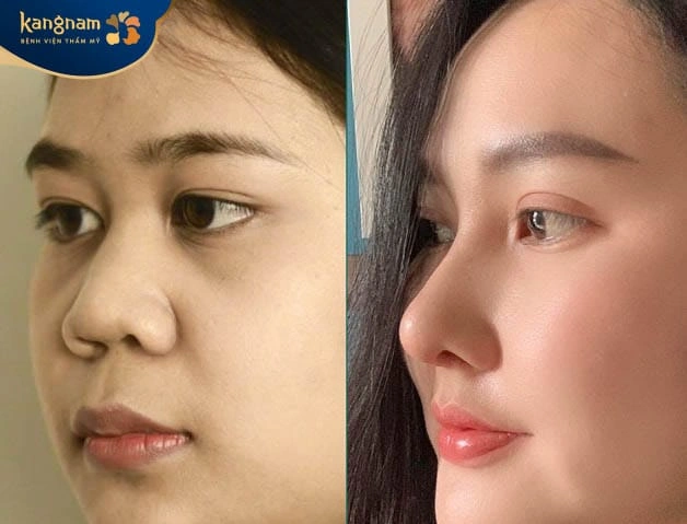 100+ Hình Ảnh Cắt Cánh Mũi 2026: Bộ Sưu Tập Đẹp Nhất, Đầy Đủ Mọi Phong Cách 100+ Hình Ảnh Cắt Cánh Mũi 2026: Bộ Sưu Tập Đẹp Nhất, Đầy Đủ Mọi Phong Cách