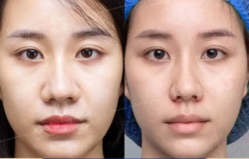 100+ Hình Ảnh Cắt Cánh Mũi 2026: Bộ Sưu Tập Đẹp Nhất, Đầy Đủ Mọi Phong Cách 100+ Hình Ảnh Cắt Cánh Mũi 2026: Bộ Sưu Tập Đẹp Nhất, Đầy Đủ Mọi Phong Cách