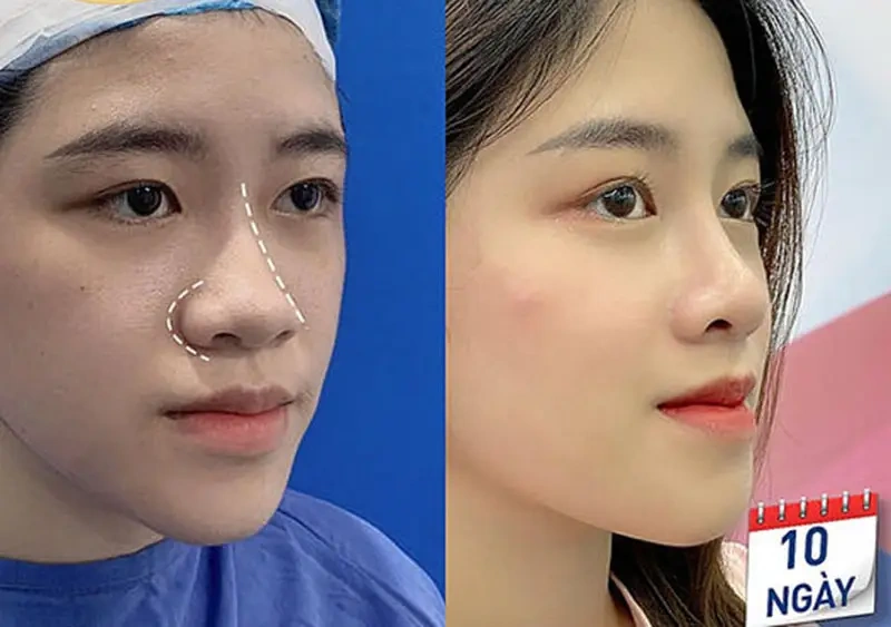 100+ Hình Ảnh Cắt Cánh Mũi 2026: Bộ Sưu Tập Đẹp Nhất, Đầy Đủ Mọi Phong Cách 100+ Hình Ảnh Cắt Cánh Mũi 2026: Bộ Sưu Tập Đẹp Nhất, Đầy Đủ Mọi Phong Cách