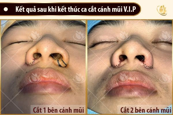 100+ Hình Ảnh Cắt Cánh Mũi 2026: Bộ Sưu Tập Đẹp Nhất, Đầy Đủ Mọi Phong Cách 100+ Hình Ảnh Cắt Cánh Mũi 2026: Bộ Sưu Tập Đẹp Nhất, Đầy Đủ Mọi Phong Cách