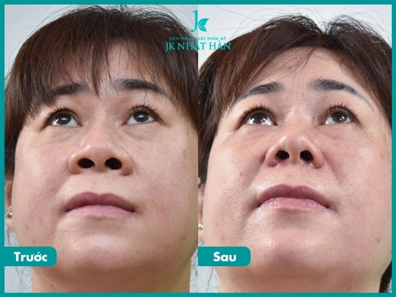 100+ Hình Ảnh Cắt Cánh Mũi 2026: Bộ Sưu Tập Đẹp Nhất, Đầy Đủ Mọi Phong Cách 100+ Hình Ảnh Cắt Cánh Mũi 2026: Bộ Sưu Tập Đẹp Nhất, Đầy Đủ Mọi Phong Cách