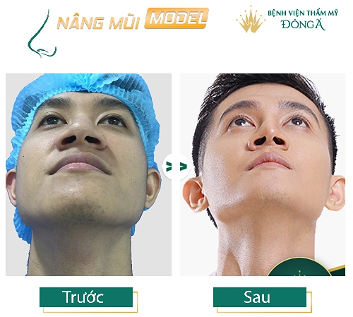 100+ Hình Ảnh Cắt Cánh Mũi 2026: Bộ Sưu Tập Đẹp Nhất, Đầy Đủ Mọi Phong Cách 100+ Hình Ảnh Cắt Cánh Mũi 2026: Bộ Sưu Tập Đẹp Nhất, Đầy Đủ Mọi Phong Cách