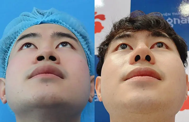 100+ Hình Ảnh Cắt Cánh Mũi 2026: Bộ Sưu Tập Đẹp Nhất, Đầy Đủ Mọi Phong Cách 100+ Hình Ảnh Cắt Cánh Mũi 2026: Bộ Sưu Tập Đẹp Nhất, Đầy Đủ Mọi Phong Cách