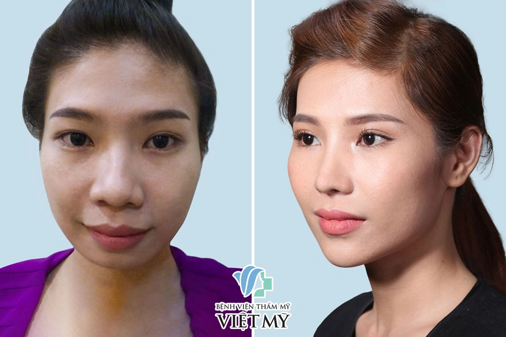 100+ Hình Ảnh Cắt Cánh Mũi 2026: Bộ Sưu Tập Đẹp Nhất, Đầy Đủ Mọi Phong Cách 100+ Hình Ảnh Cắt Cánh Mũi 2026: Bộ Sưu Tập Đẹp Nhất, Đầy Đủ Mọi Phong Cách