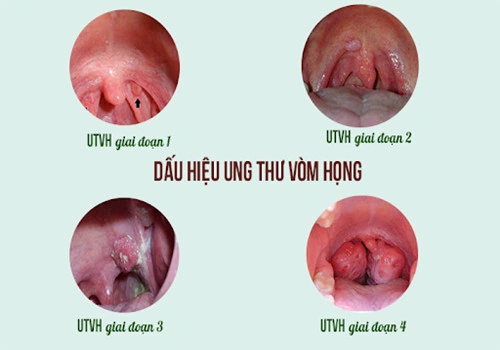 Hình Ảnh Cổ Họng Người Bình Thường: Đánh Giá, Nhận Diện & So Sánh Cho Người Tự Kiểm Tra Và Chuyên Gia Y Tế Hình Ảnh Cổ Họng Người Bình Thường: Đánh Giá, Nhận Diện & So Sánh Cho Người Tự Kiểm Tra Và Chuyên Gia Y Tế