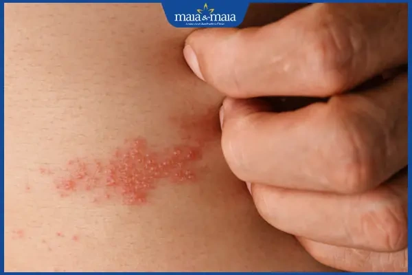 Hình Ảnh Zona Thần Kinh: Nhận Diện, Các Giai Đoạn & Cách Phòng Ngừa Cho Người Bệnh Và Người Chăm Sóc