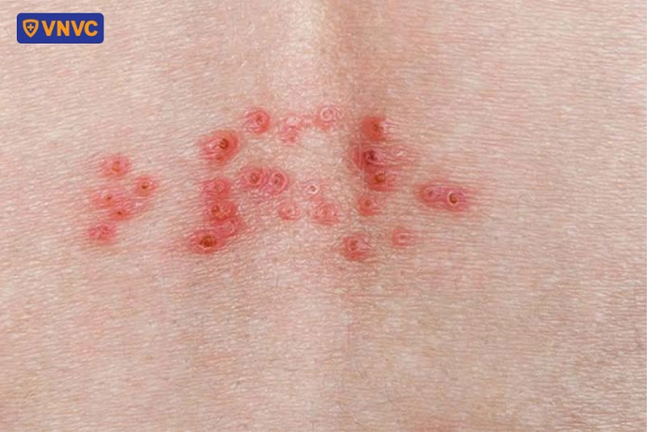 Hình Ảnh Zona Thần Kinh: Nhận Diện, Các Giai Đoạn & Cách Phòng Ngừa Cho Người Bệnh Và Người Chăm Sóc
