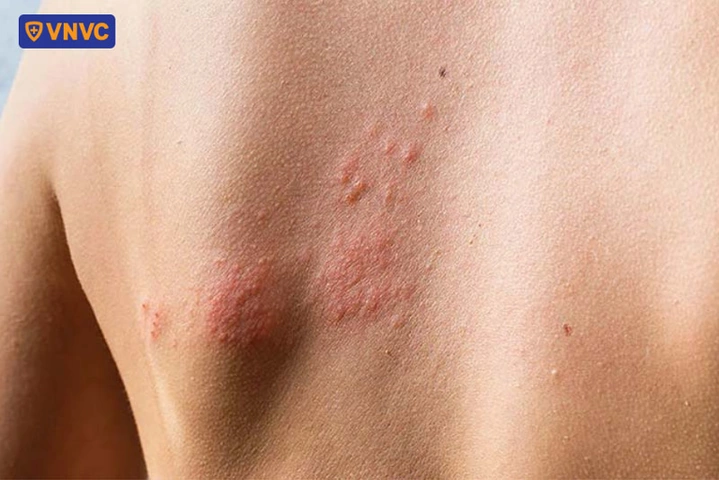 Hình Ảnh Zona Thần Kinh: Nhận Diện, Các Giai Đoạn & Cách Phòng Ngừa Cho Người Bệnh Và Người Chăm Sóc