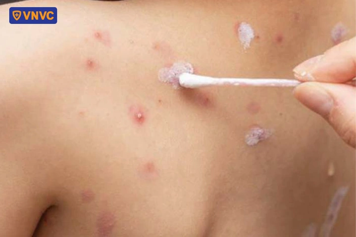 Hình Ảnh Zona Thần Kinh: Nhận Diện, Các Giai Đoạn & Cách Phòng Ngừa Cho Người Bệnh Và Người Chăm Sóc