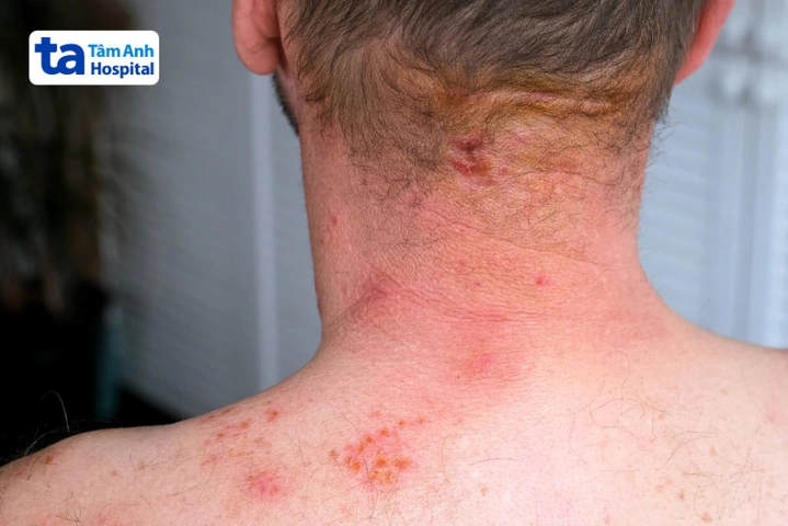Hình Ảnh Zona Thần Kinh: Nhận Diện, Các Giai Đoạn & Cách Phòng Ngừa Cho Người Bệnh Và Người Chăm Sóc