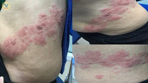 Hình Ảnh Zona Thần Kinh: Nhận Diện, Các Giai Đoạn & Cách Phòng Ngừa Cho Người Bệnh Và Người Chăm Sóc