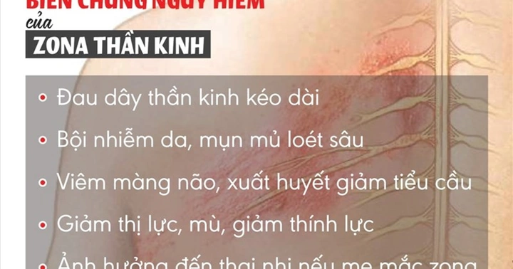 Hình Ảnh Zona Thần Kinh: Nhận Diện, Các Giai Đoạn & Cách Phòng Ngừa Cho Người Bệnh Và Người Chăm Sóc