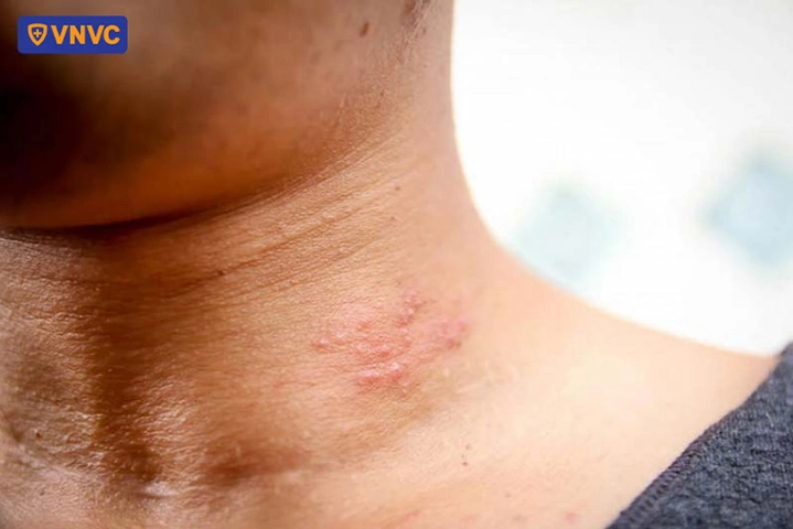 Hình Ảnh Zona Thần Kinh: Nhận Diện, Các Giai Đoạn & Cách Phòng Ngừa Cho Người Bệnh Và Người Chăm Sóc