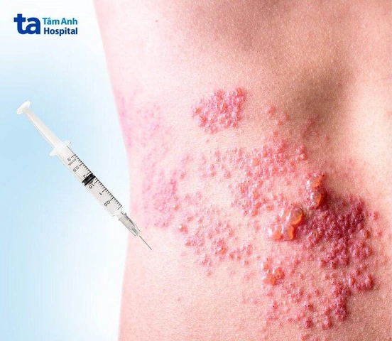 Hình Ảnh Zona Thần Kinh: Nhận Diện, Các Giai Đoạn & Cách Phòng Ngừa Cho Người Bệnh Và Người Chăm Sóc