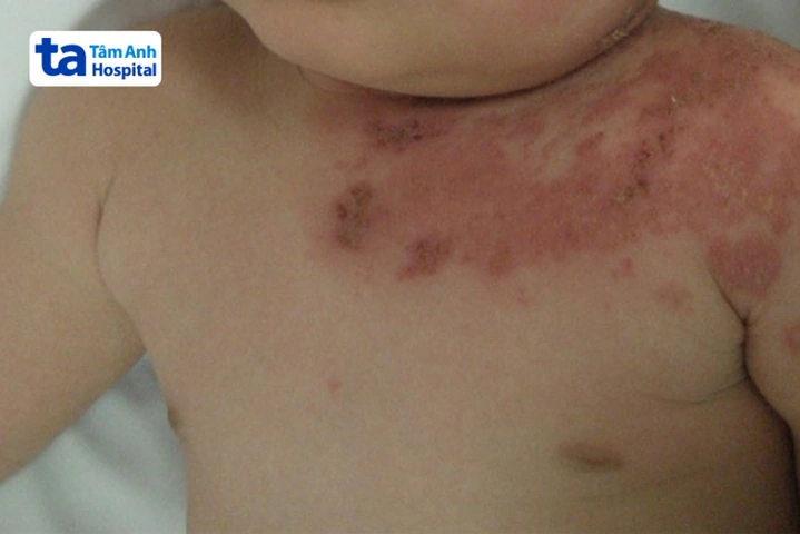 Hình Ảnh Zona Thần Kinh: Nhận Diện, Các Giai Đoạn & Cách Phòng Ngừa Cho Người Bệnh Và Người Chăm Sóc
