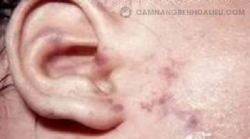 Hình Ảnh Zona Thần Kinh: Nhận Diện, Các Giai Đoạn & Cách Phòng Ngừa Cho Người Bệnh Và Người Chăm Sóc