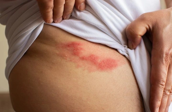 Hình Ảnh Zona Thần Kinh: Nhận Diện, Các Giai Đoạn & Cách Phòng Ngừa Cho Người Bệnh Và Người Chăm Sóc