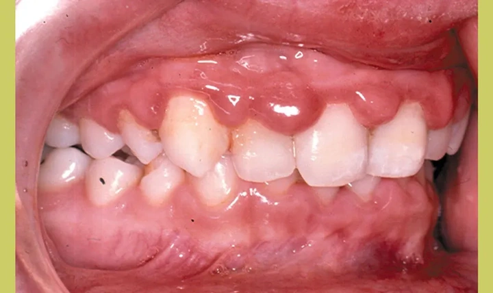 Hình Ảnh Em Bé Sún Răng: Nhận Dạng, Nguyên Nhân & Cách Điều Trị Hiệu Quả Cho Mẹ Bỉm Sữa Hình Ảnh Em Bé Sún Răng: Nhận Dạng, Nguyên Nhân & Cách Điều Trị Hiệu Quả Cho Mẹ Bỉm Sữa