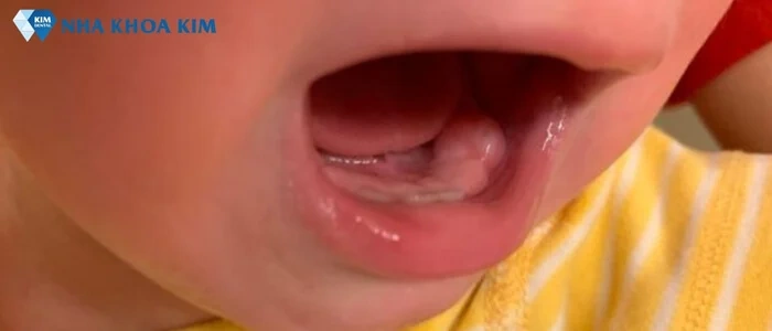 Hình Ảnh Em Bé Sún Răng: Nhận Dạng, Nguyên Nhân & Cách Điều Trị Hiệu Quả Cho Mẹ Bỉm Sữa Hình Ảnh Em Bé Sún Răng: Nhận Dạng, Nguyên Nhân & Cách Điều Trị Hiệu Quả Cho Mẹ Bỉm Sữa