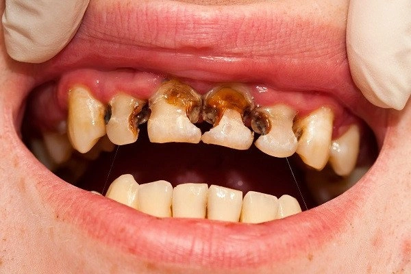 Hình Ảnh Em Bé Sún Răng: Nhận Dạng, Nguyên Nhân & Cách Điều Trị Hiệu Quả Cho Mẹ Bỉm Sữa Hình Ảnh Em Bé Sún Răng: Nhận Dạng, Nguyên Nhân & Cách Điều Trị Hiệu Quả Cho Mẹ Bỉm Sữa