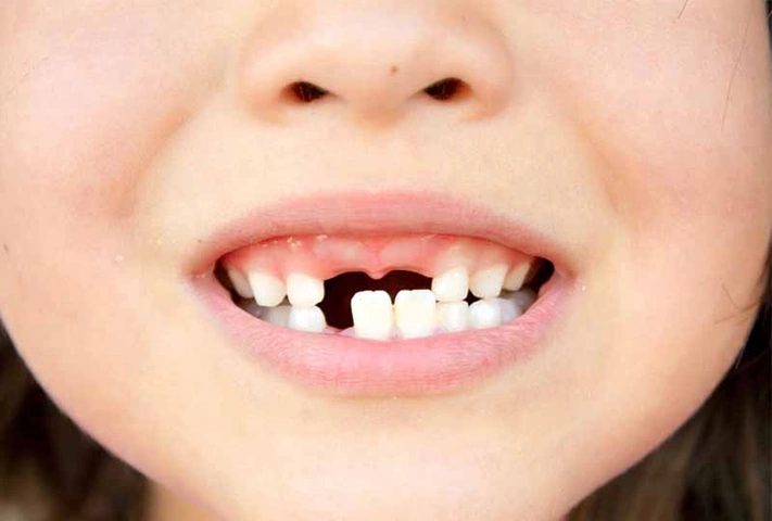 Hình Ảnh Em Bé Sún Răng: Nhận Dạng, Nguyên Nhân & Cách Điều Trị Hiệu Quả Cho Mẹ Bỉm Sữa Hình Ảnh Em Bé Sún Răng: Nhận Dạng, Nguyên Nhân & Cách Điều Trị Hiệu Quả Cho Mẹ Bỉm Sữa
