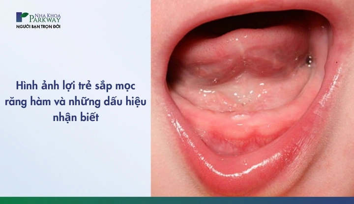 Hình Ảnh Em Bé Sún Răng: Nhận Dạng, Nguyên Nhân & Cách Điều Trị Hiệu Quả Cho Mẹ Bỉm Sữa Hình Ảnh Em Bé Sún Răng: Nhận Dạng, Nguyên Nhân & Cách Điều Trị Hiệu Quả Cho Mẹ Bỉm Sữa