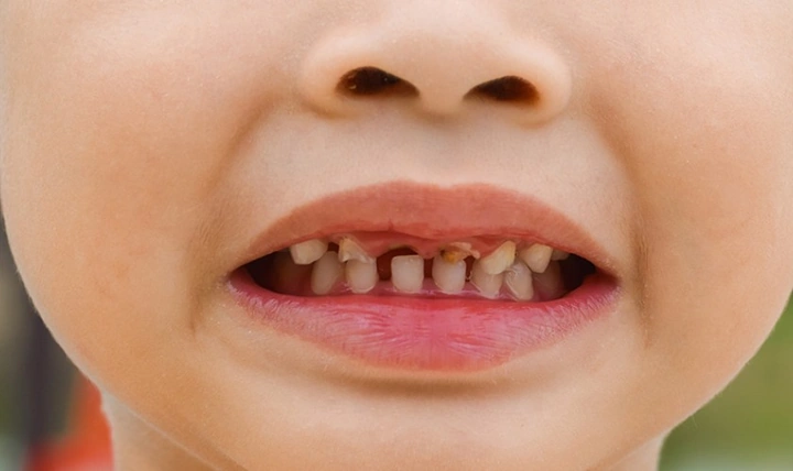 Hình Ảnh Em Bé Sún Răng: Nhận Dạng, Nguyên Nhân & Cách Điều Trị Hiệu Quả Cho Mẹ Bỉm Sữa Hình Ảnh Em Bé Sún Răng: Nhận Dạng, Nguyên Nhân & Cách Điều Trị Hiệu Quả Cho Mẹ Bỉm Sữa