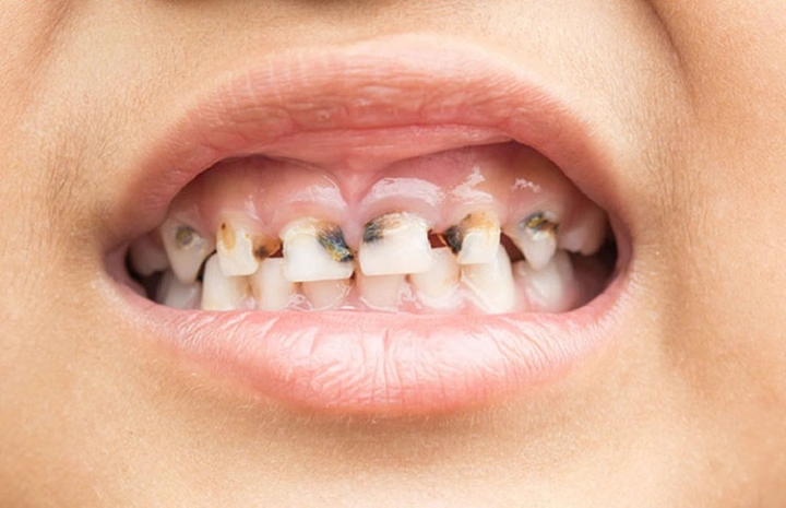 Hình Ảnh Em Bé Sún Răng: Nhận Dạng, Nguyên Nhân & Cách Điều Trị Hiệu Quả Cho Mẹ Bỉm Sữa Hình Ảnh Em Bé Sún Răng: Nhận Dạng, Nguyên Nhân & Cách Điều Trị Hiệu Quả Cho Mẹ Bỉm Sữa