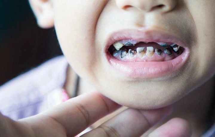 Hình Ảnh Em Bé Sún Răng: Nhận Dạng, Nguyên Nhân & Cách Điều Trị Hiệu Quả Cho Mẹ Bỉm Sữa Hình Ảnh Em Bé Sún Răng: Nhận Dạng, Nguyên Nhân & Cách Điều Trị Hiệu Quả Cho Mẹ Bỉm Sữa