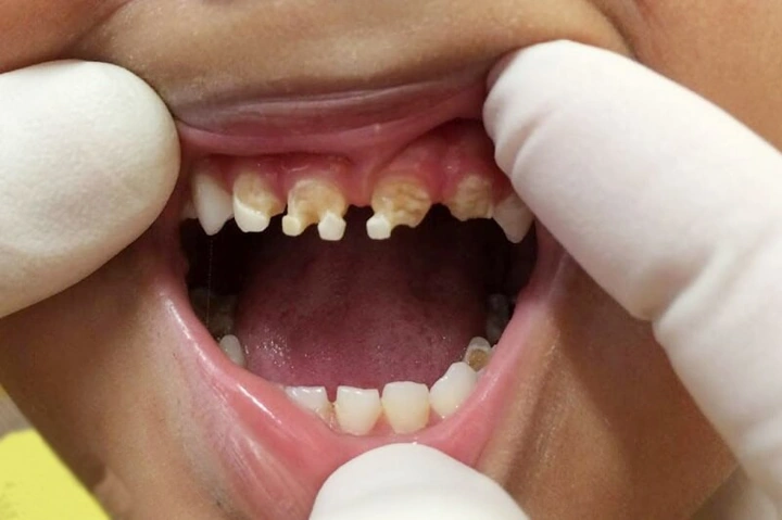Hình Ảnh Em Bé Sún Răng: Nhận Dạng, Nguyên Nhân & Cách Điều Trị Hiệu Quả Cho Mẹ Bỉm Sữa Hình Ảnh Em Bé Sún Răng: Nhận Dạng, Nguyên Nhân & Cách Điều Trị Hiệu Quả Cho Mẹ Bỉm Sữa