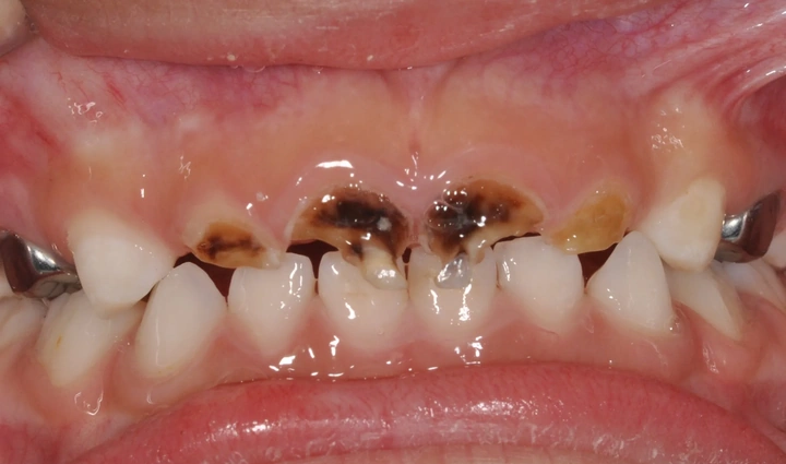 Hình Ảnh Em Bé Sún Răng: Nhận Dạng, Nguyên Nhân & Cách Điều Trị Hiệu Quả Cho Mẹ Bỉm Sữa Hình Ảnh Em Bé Sún Răng: Nhận Dạng, Nguyên Nhân & Cách Điều Trị Hiệu Quả Cho Mẹ Bỉm Sữa