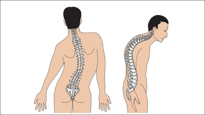 Hình Ảnh Gai Cột Sống Thắt Lưng: Định Nghĩa, Nguyên Nhân, Triệu Chứng & Cách Điều Trị Dành Cho Người Mới Bắt Đầu
