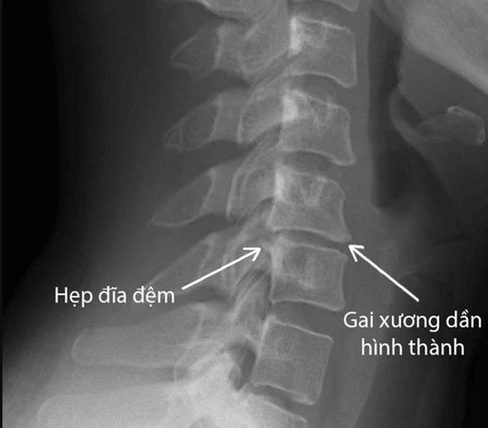 Hình Ảnh Gai Cột Sống Thắt Lưng: Định Nghĩa, Nguyên Nhân, Triệu Chứng & Cách Điều Trị Dành Cho Người Mới Bắt Đầu