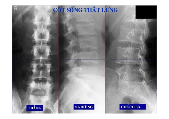 Hình Ảnh Gai Cột Sống Thắt Lưng: Định Nghĩa, Nguyên Nhân, Triệu Chứng & Cách Điều Trị Dành Cho Người Mới Bắt Đầu