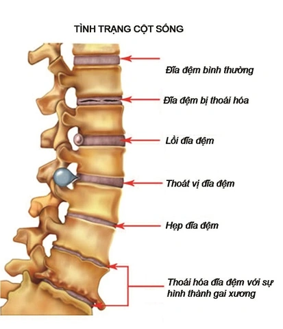 Hình Ảnh Gai Cột Sống Thắt Lưng: Định Nghĩa, Nguyên Nhân, Triệu Chứng & Cách Điều Trị Dành Cho Người Mới Bắt Đầu